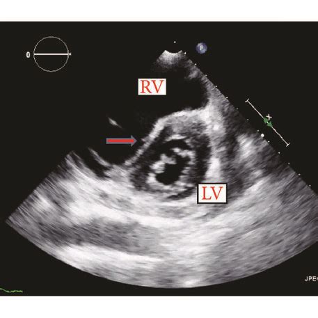 d shaped left ventricle symptoms.